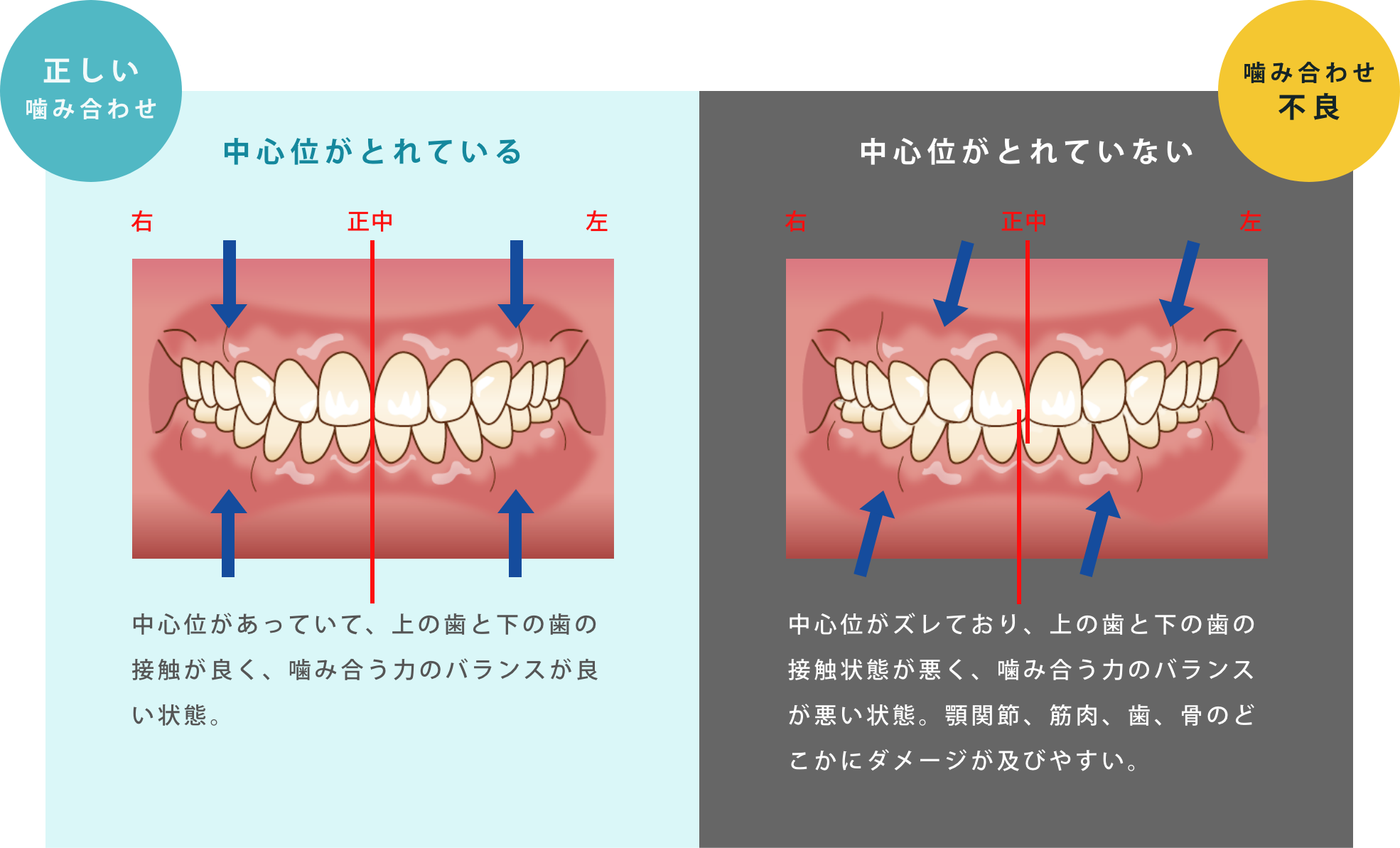 「中心位」がとれている=上と下の前歯の真ん中があっている