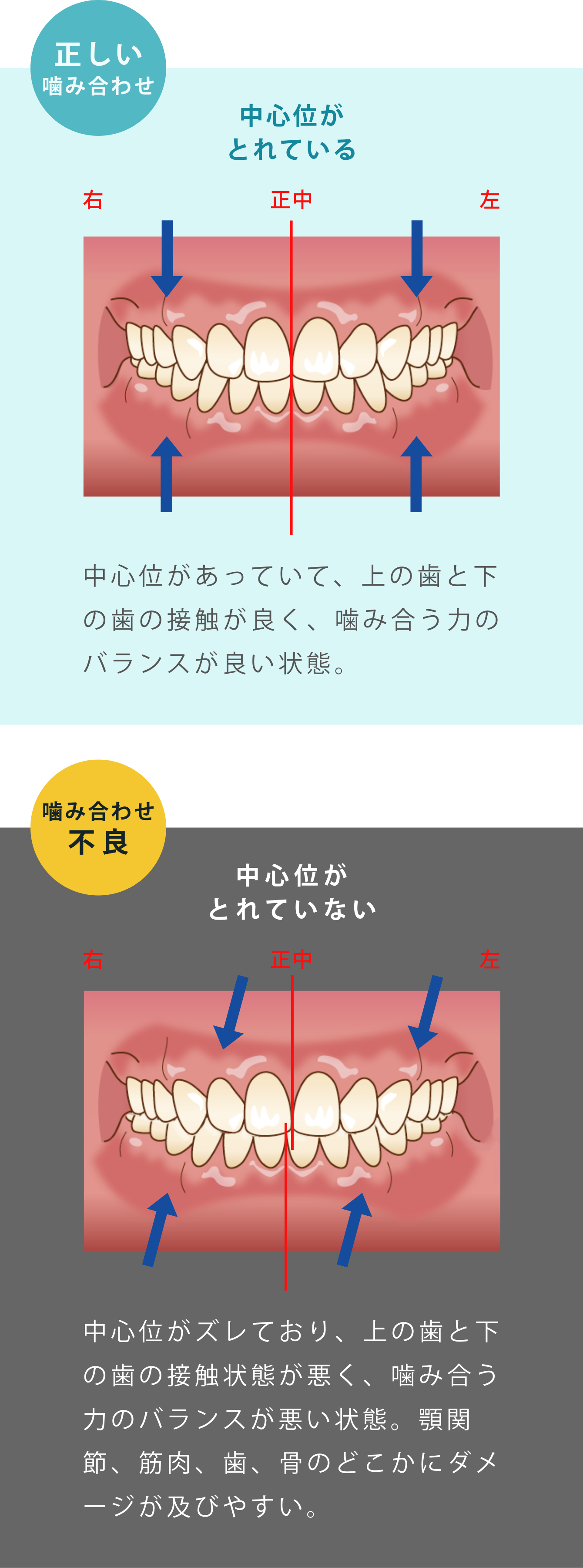 「中心位」がとれている=上と下の前歯の真ん中があっている